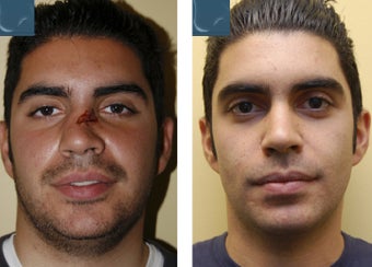 Nasal Reconstruction, Revision Rhinoplasty