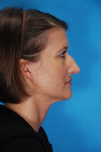 Rhinoplasty