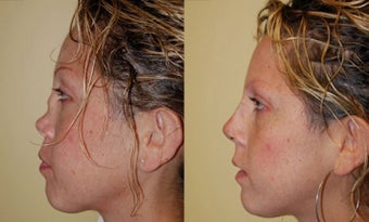 Revision Rhinoplasty Nose Surgery