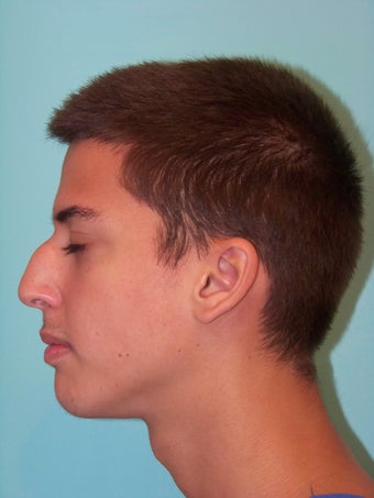 Male Nose Job- Rhinoplasty