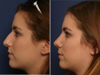 Nose