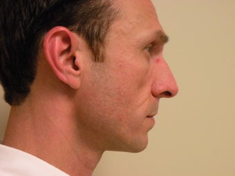 Rhinoplasty 