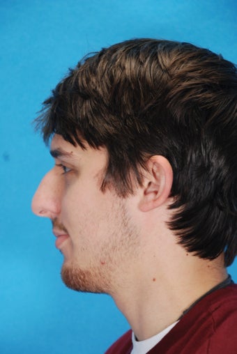 Rhinoplasty (nose job)