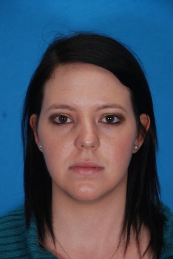 Rhinoplasty (nose job)