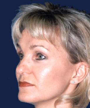 rhinoplasty