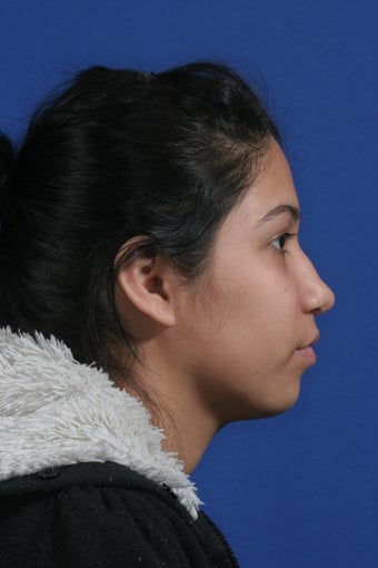 nasal airway surgery with cosmetic benefits