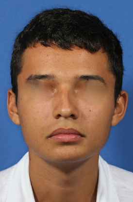 nasal airway surgery with cosmetic improvement