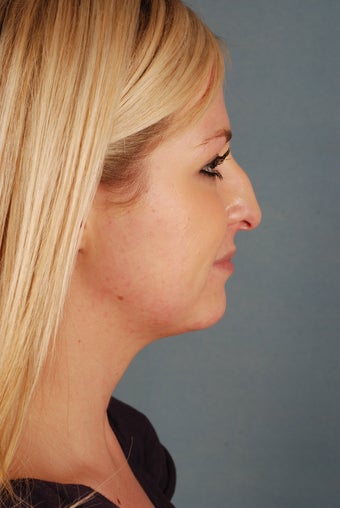 Closed Rhinoplasty