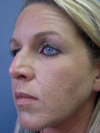 Rhinoplasty