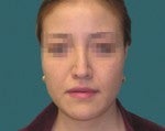 Nose Surgery -Rhinoplasty