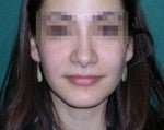 Rhinoplasty