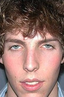 Nose Surgery, Rhinoplasty