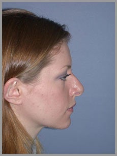 Nose Surgery, Rhinoplasty