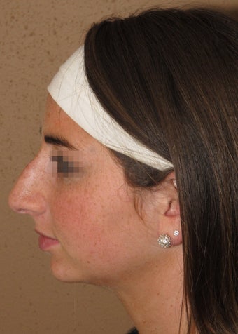 rhinoplasty