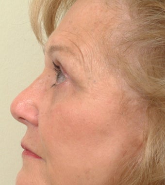 Pearl Laser Treatment