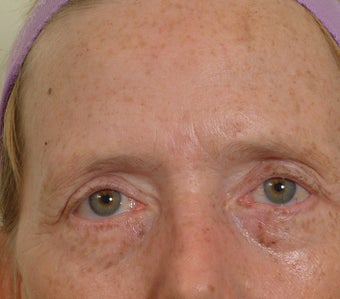 Pearl Laser Treatment