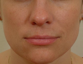 Pearl Laser Treatment