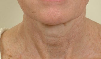 Pearl Laser Treatment