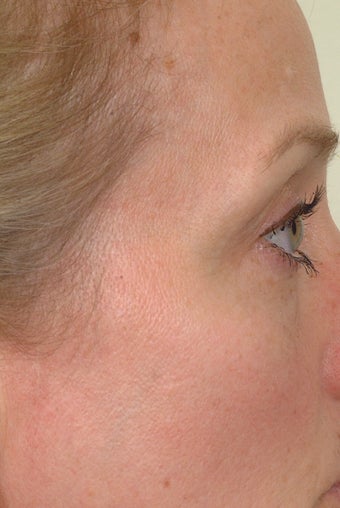 Pearl Laser Treatment