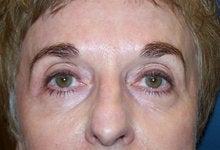 Pearl Fractional Laser