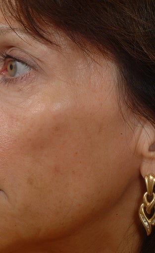 Pearl Laser Treatment