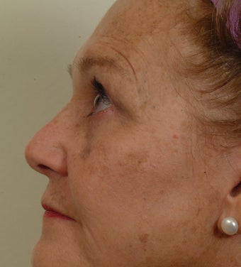 Pearl Laser Treatment