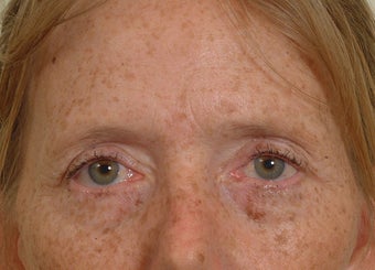 Pearl Laser Treatment