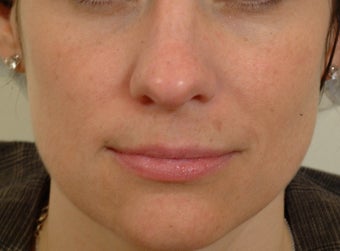 Pearl Laser Treatment
