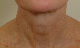 Pearl Laser Treatment