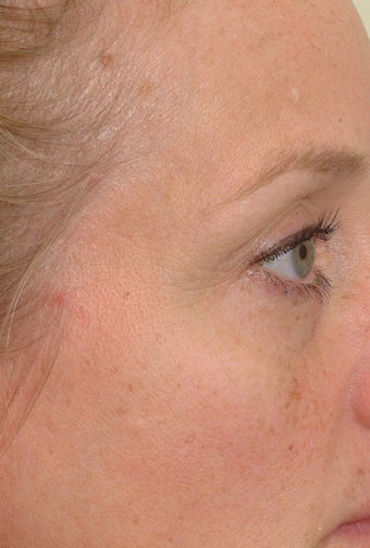 Pearl Laser Treatment