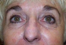 Pearl Fractional Laser