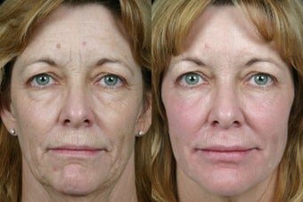 Pearl Fractional