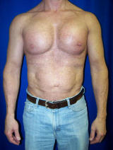 Pec Implants