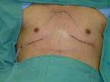 Chest Wall Reconstruction Surgery