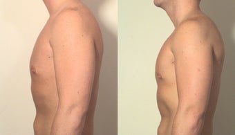 Pectoral implants