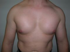 Pec Implants