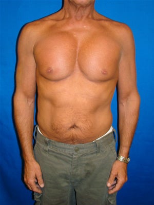 Pectoral Implants