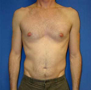 Pectoral Augmentation Surgery