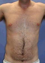 Pectoral Implants