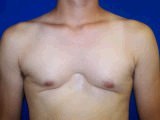Chest Wall Reconstruction Surgery