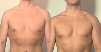 Pectoral implants