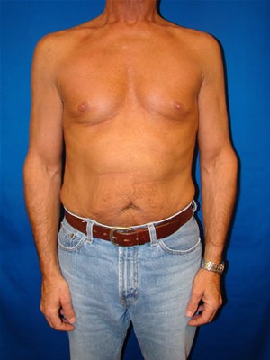 Pectoral Implants