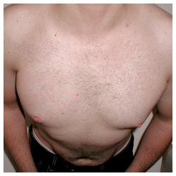 Chest implant for patient with Poland’s syndrome