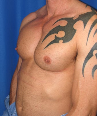 Pec Implants 