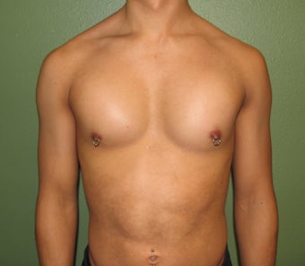 Pectoral Implants