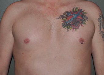 Pec Implants