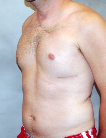 Male Chest Enhancement