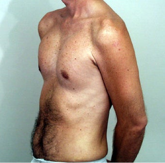 Male Chest Enhancement