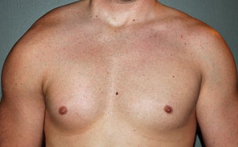 Pectoral Implants