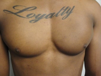 Pectoral Implants